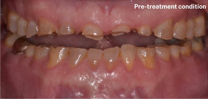 before Crown lengthening & rehabilitation