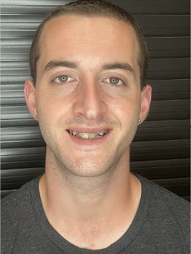 before Guided full-arch implant treatment