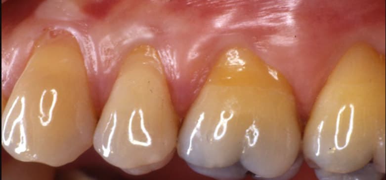 before Connective tissue grafting