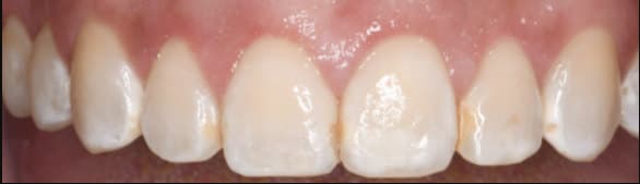 after Full-arch crown lengthening