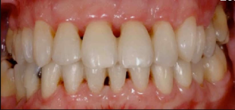 after LANAP & restorative care
