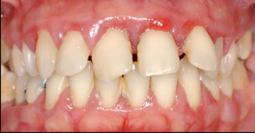 before LANAP & restorative care