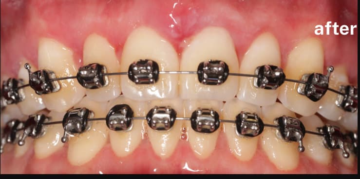 after Gingivectomy during orthodontic care