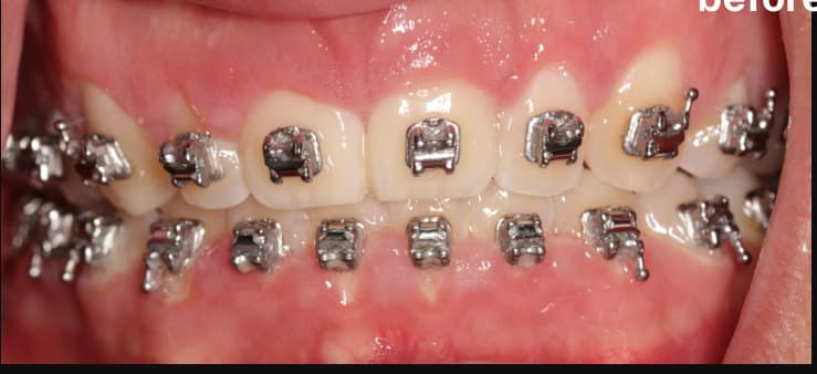 before Gingivectomy during orthodontic care