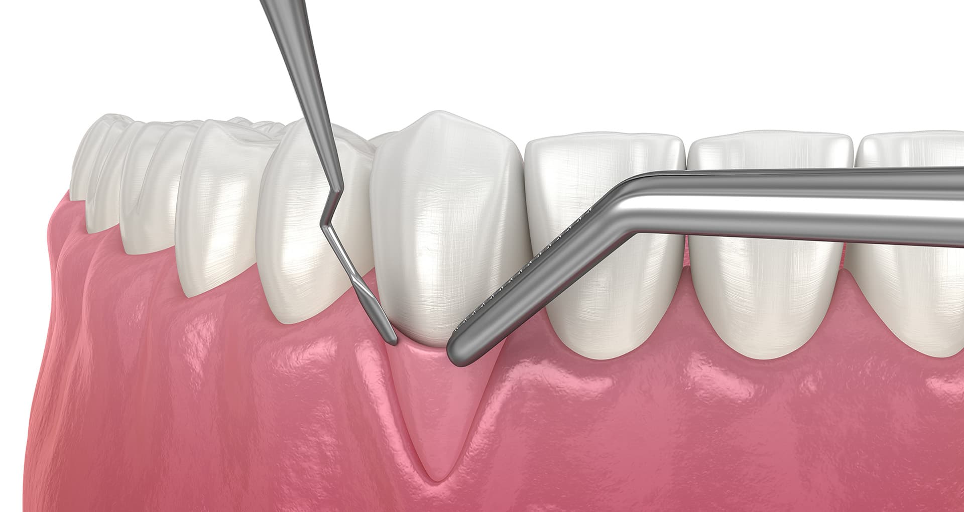 Gum grafting procedure to restore receding gum tissue