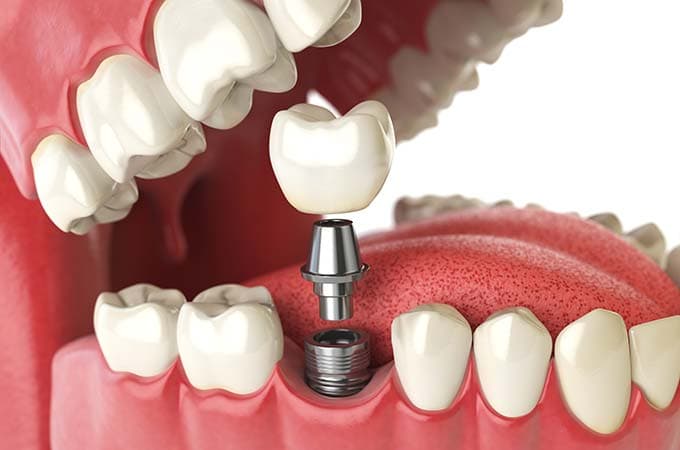 Bone Grafting for Dental Implants